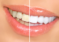 Teeth Whitening | Dentist in West Hempstead, NY | Confident Smile Dental